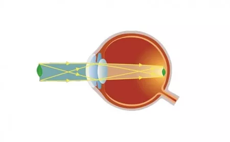 Augenkrankheit - Hornhautverkrümmung